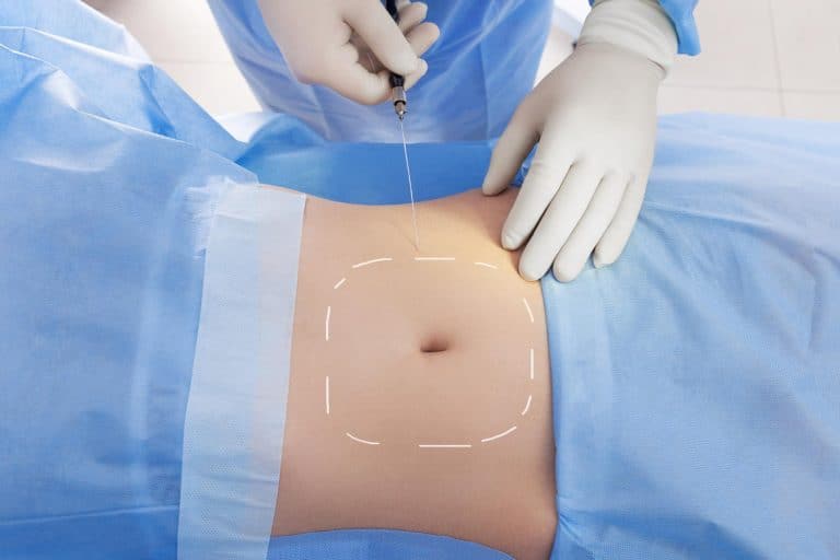 Quelles sont les conditions pour bénéficier d’une prise en charge de l’abdominoplastie ?